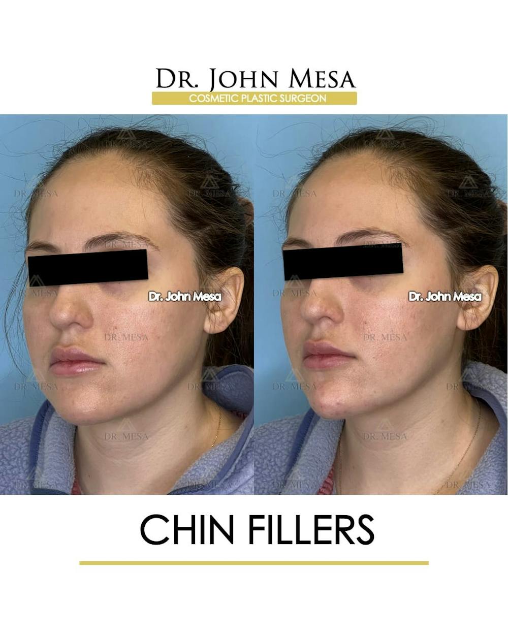 Chin Filler Before & After Gallery - Patient 491875 - Image 4