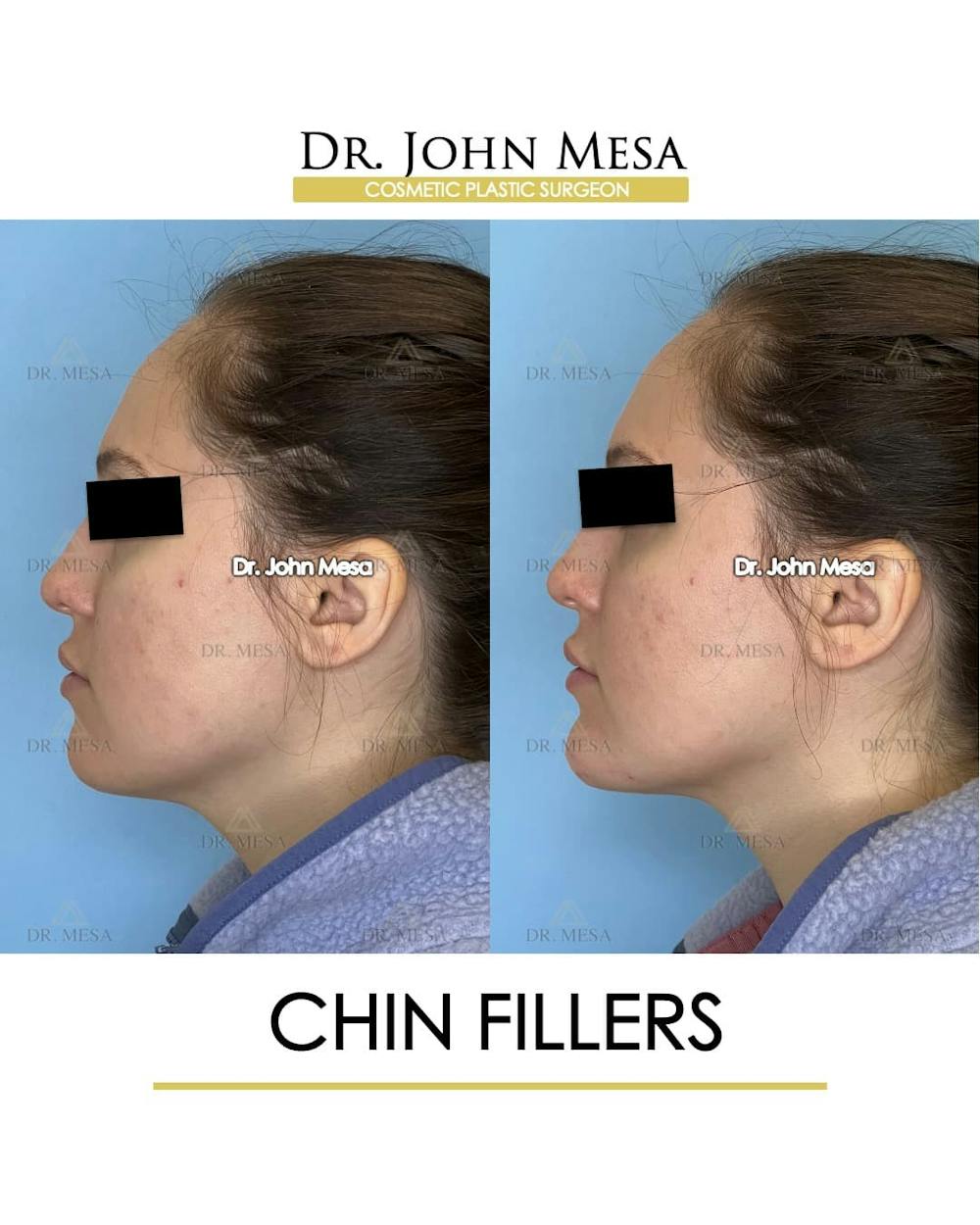 Chin Filler Before & After Gallery - Patient 491875 - Image 5
