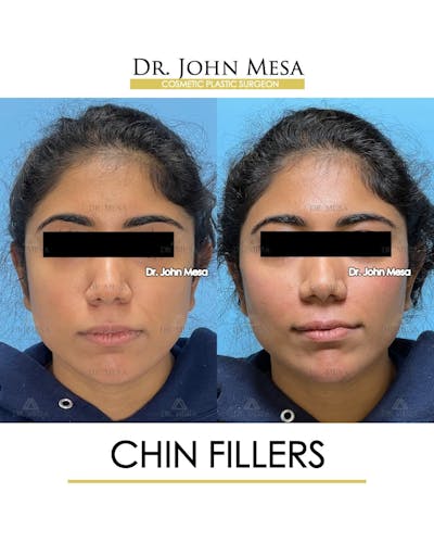 Chin Filler Before & After Gallery - Patient 705146 - Image 1
