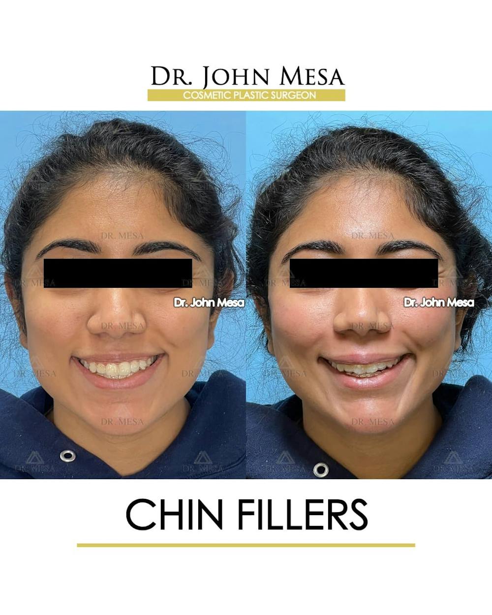 Chin Filler Before & After Gallery - Patient 705146 - Image 2