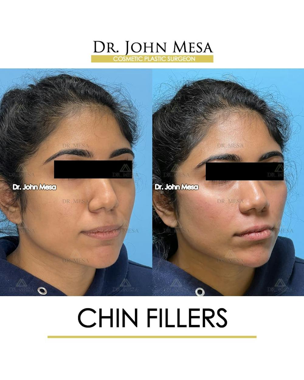 Chin Filler Before & After Gallery - Patient 705146 - Image 3
