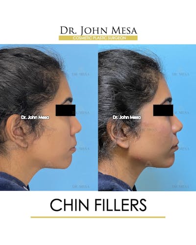 Chin Filler Before & After Gallery - Patient 705146 - Image 4
