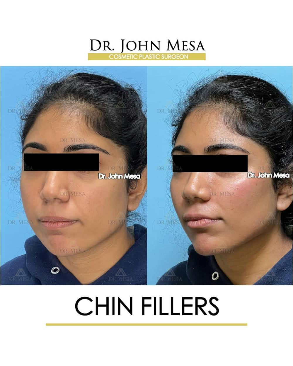 Chin Filler Before & After Gallery - Patient 705146 - Image 5