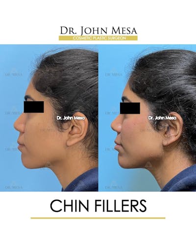 Chin Filler Before & After Gallery - Patient 705146 - Image 6