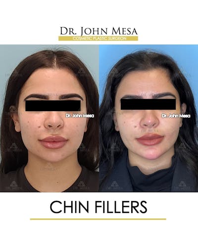Chin Filler Before & After Gallery - Patient 388260 - Image 1