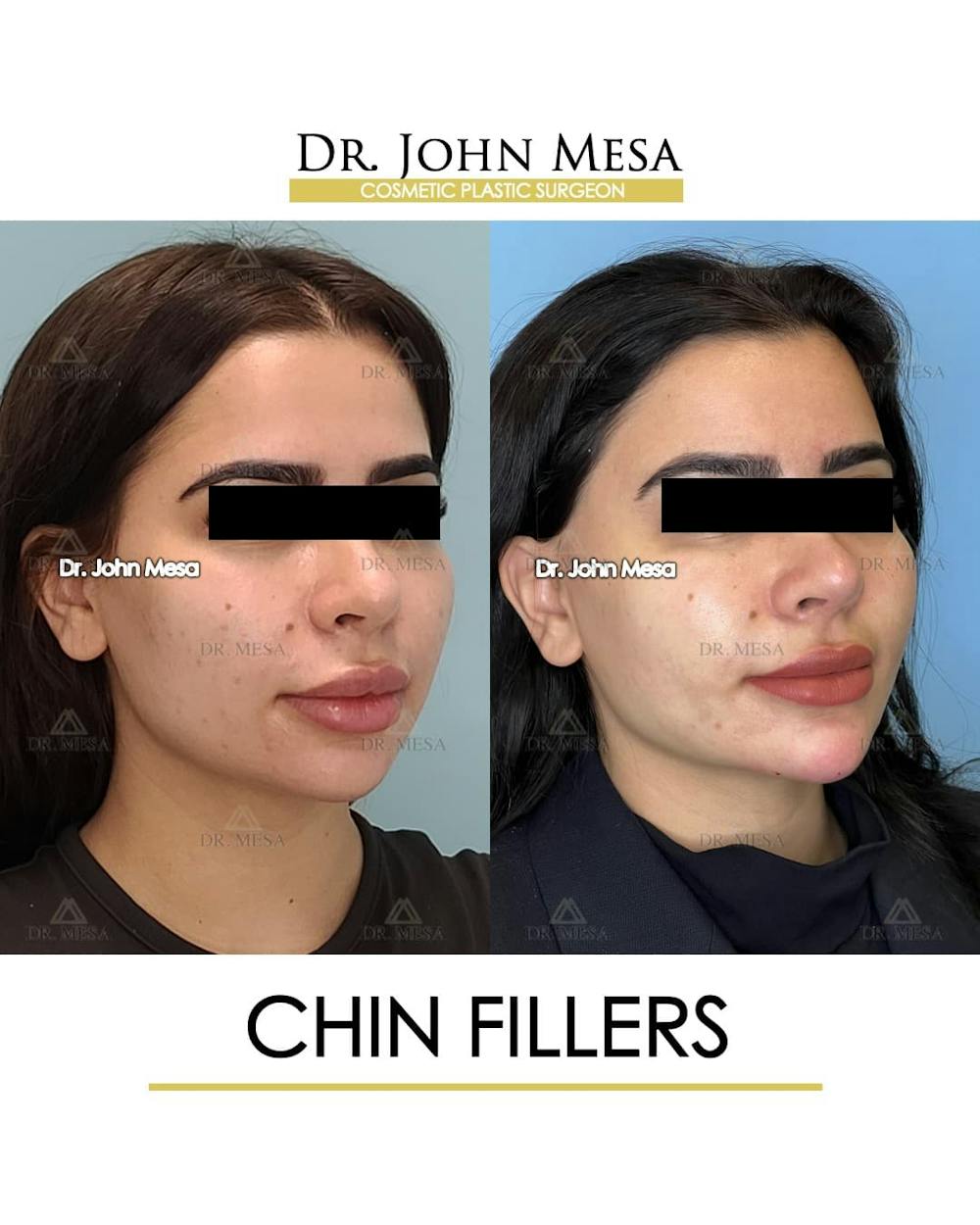 Chin Filler Before & After Gallery - Patient 388260 - Image 2
