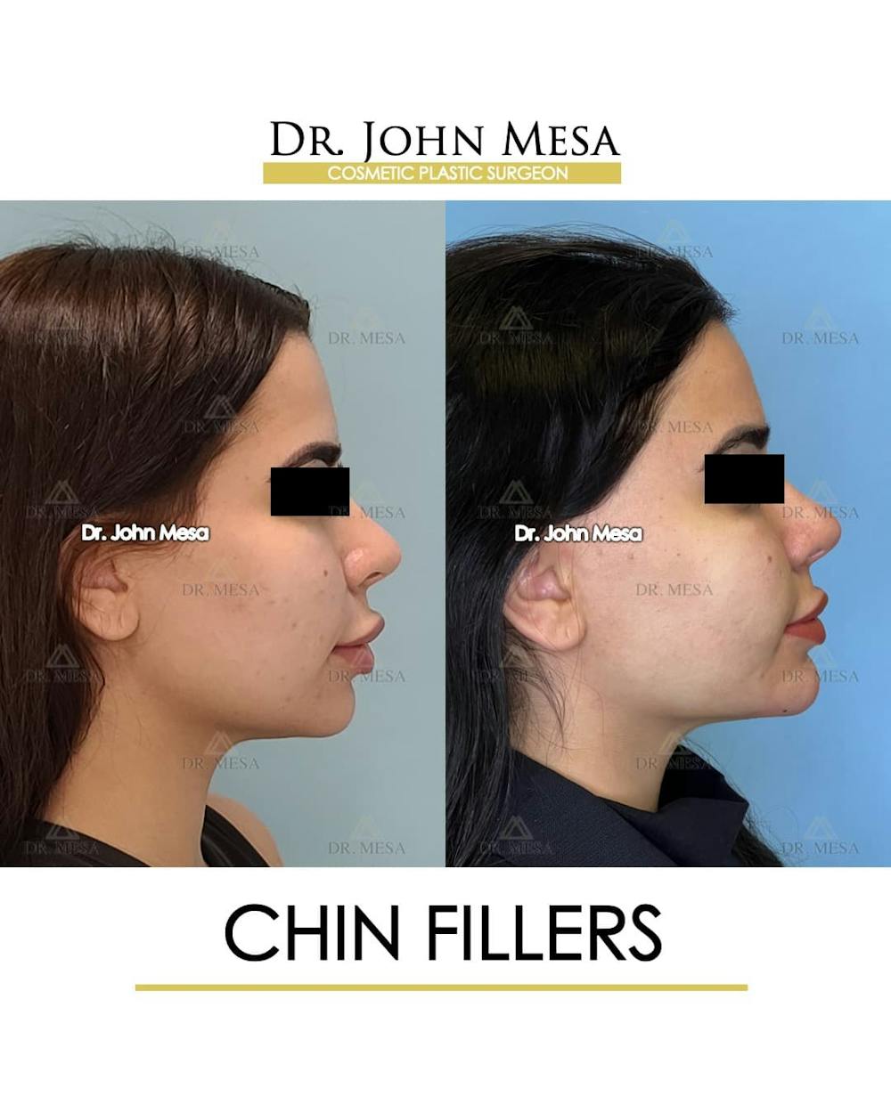 Chin Filler Before & After Gallery - Patient 388260 - Image 3
