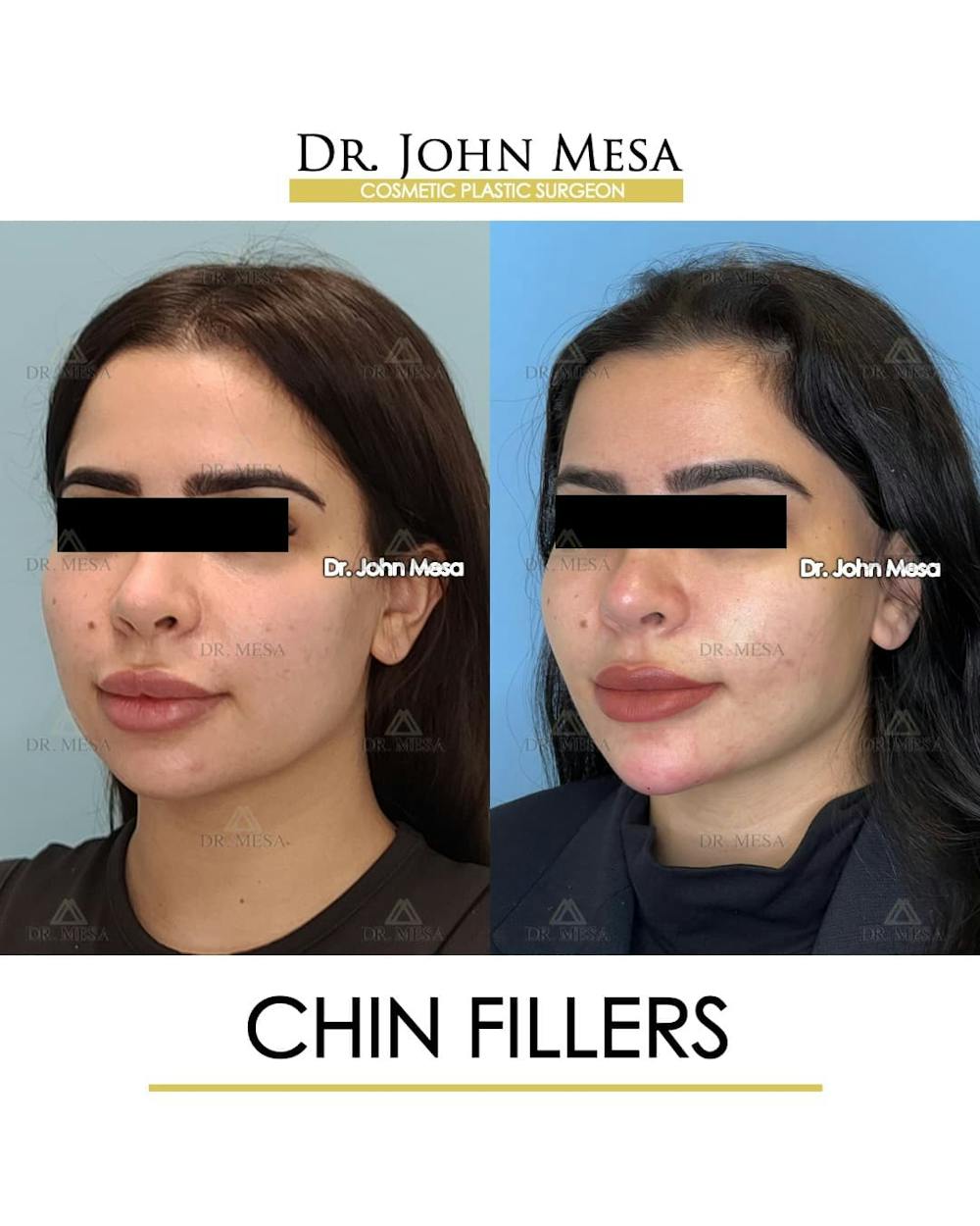 Chin Filler Before & After Gallery - Patient 388260 - Image 4