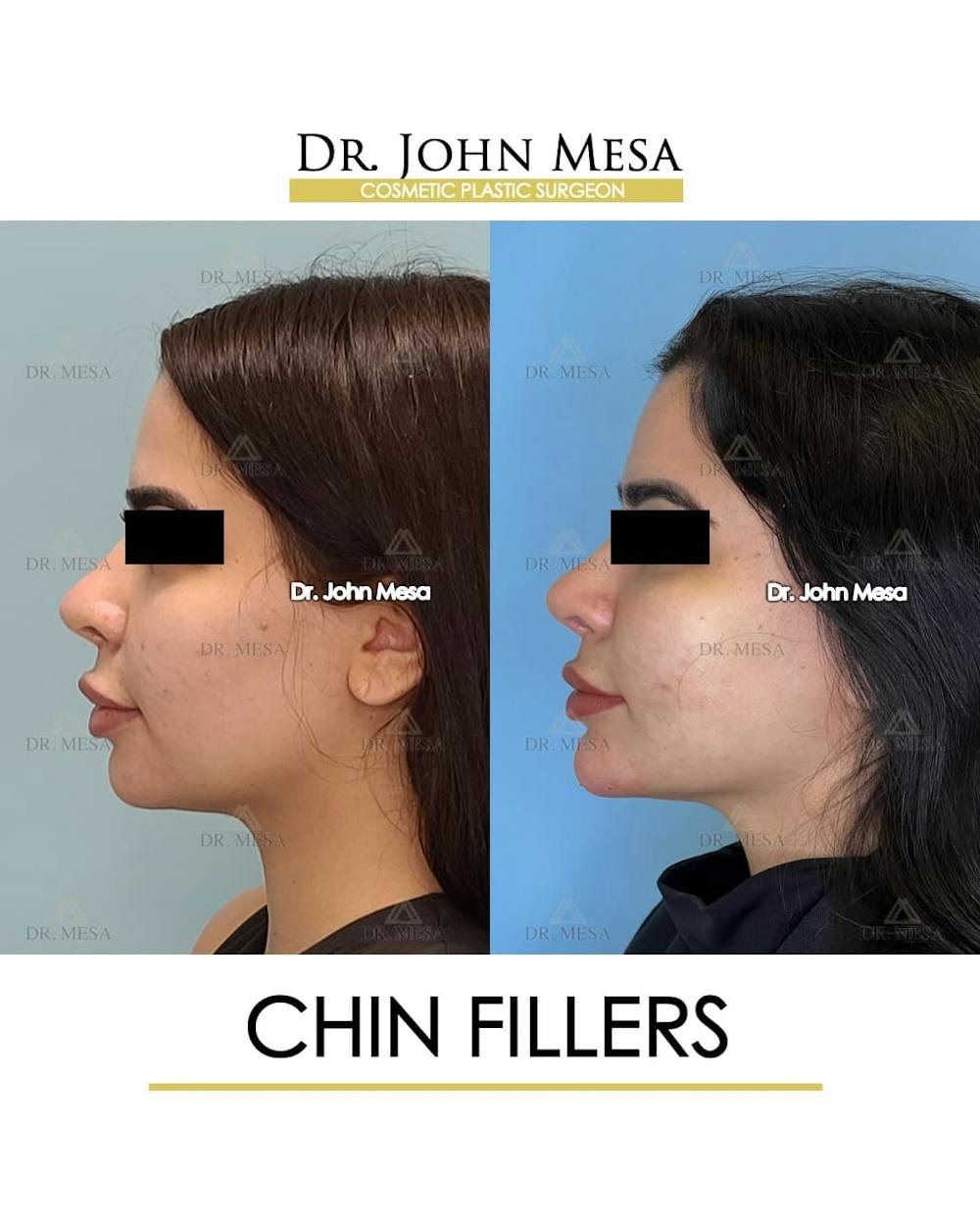 Chin Filler Before & After Gallery - Patient 388260 - Image 5