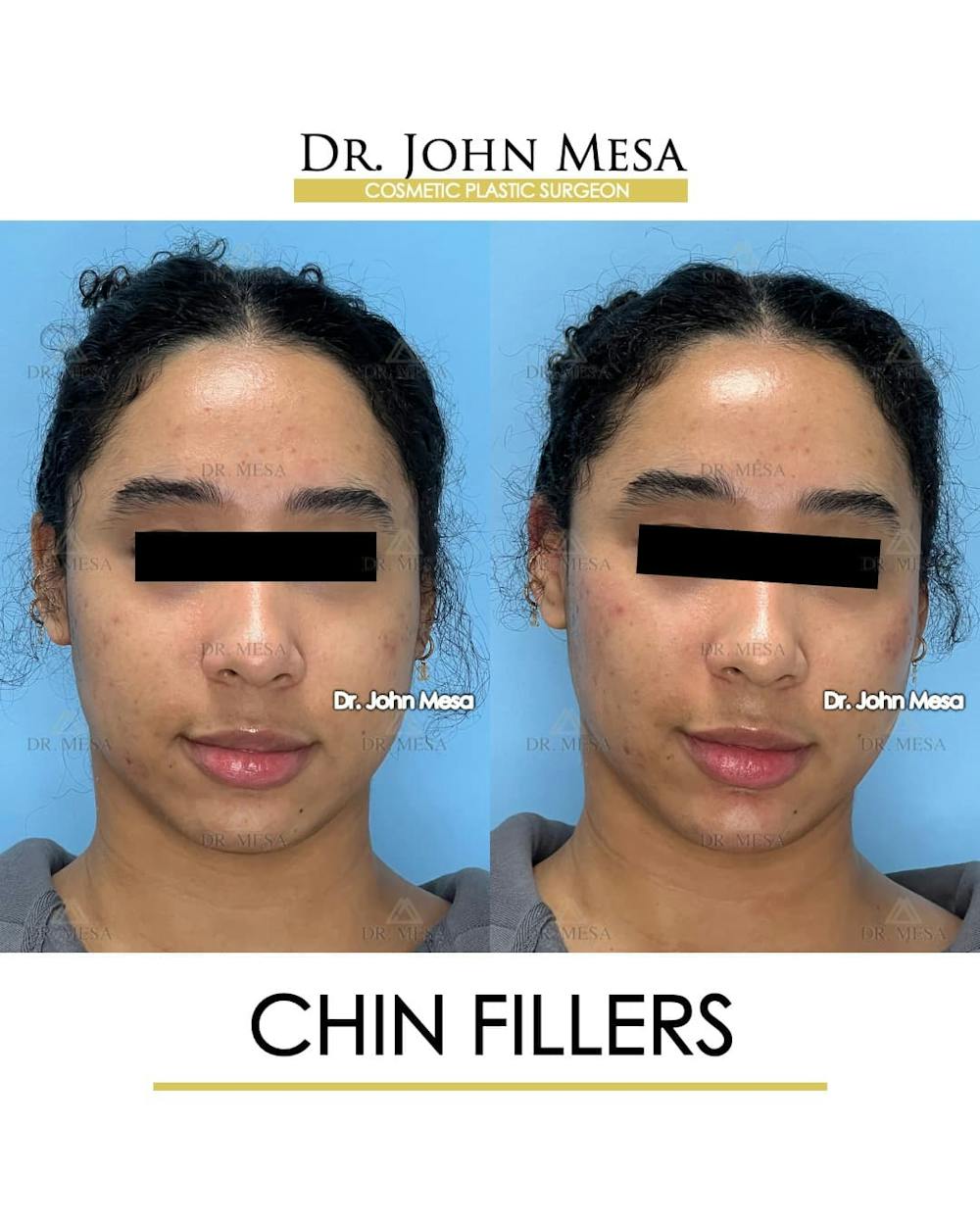 Chin Filler Before & After Gallery - Patient 712465 - Image 1