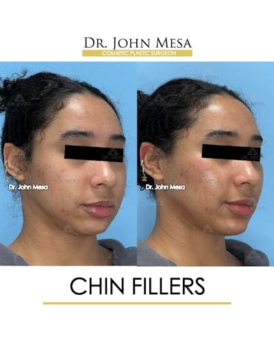 Chin Filler Before & After Gallery - Patient 712465 - Image 2
