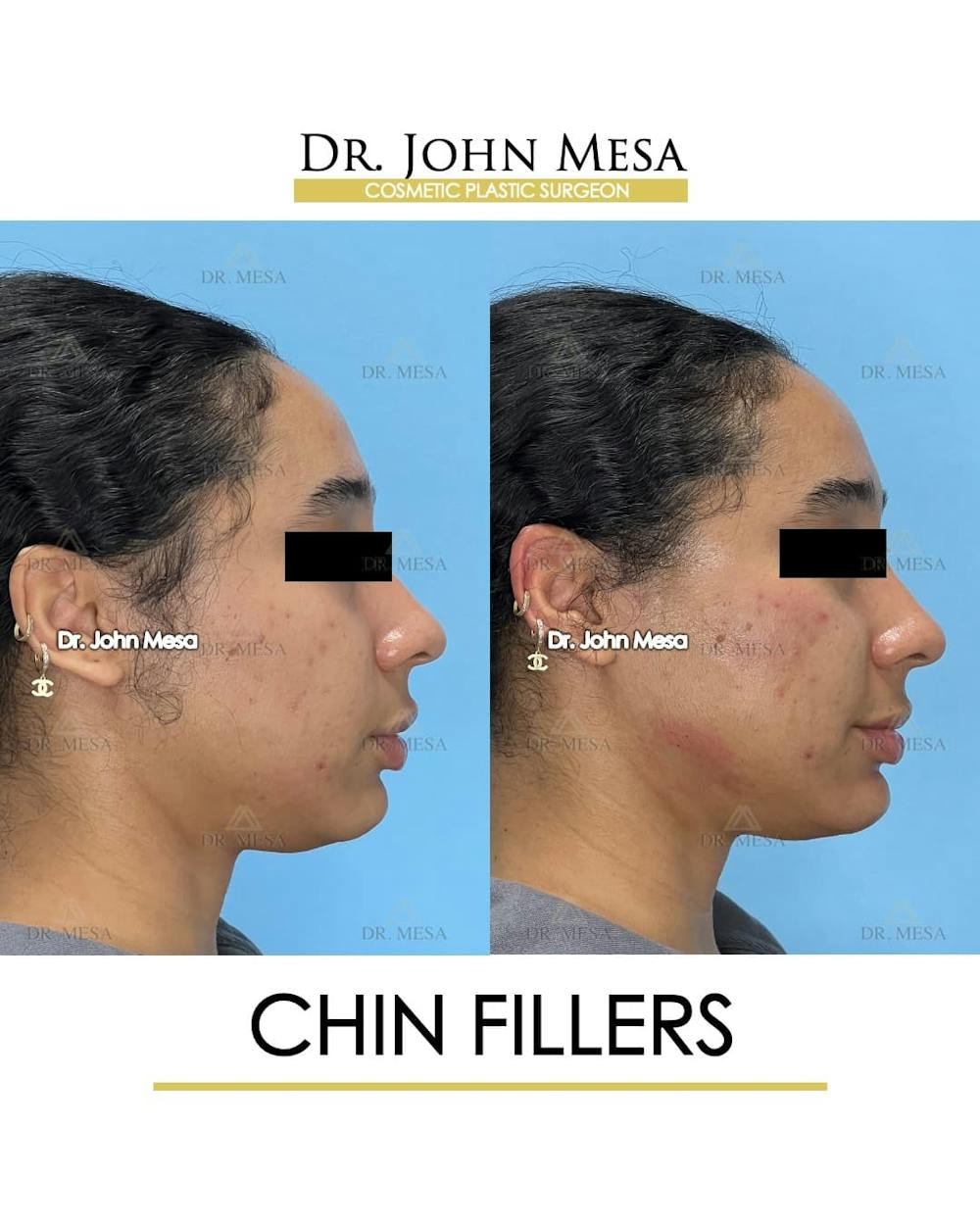 Chin Filler Before & After Gallery - Patient 712465 - Image 3
