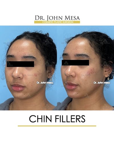 Chin Filler Before & After Gallery - Patient 712465 - Image 4
