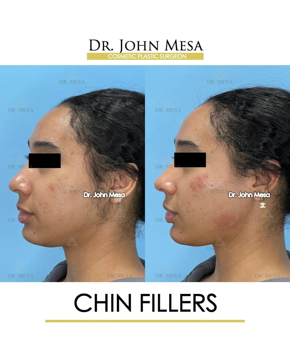 Chin Filler Before & After Gallery - Patient 712465 - Image 5