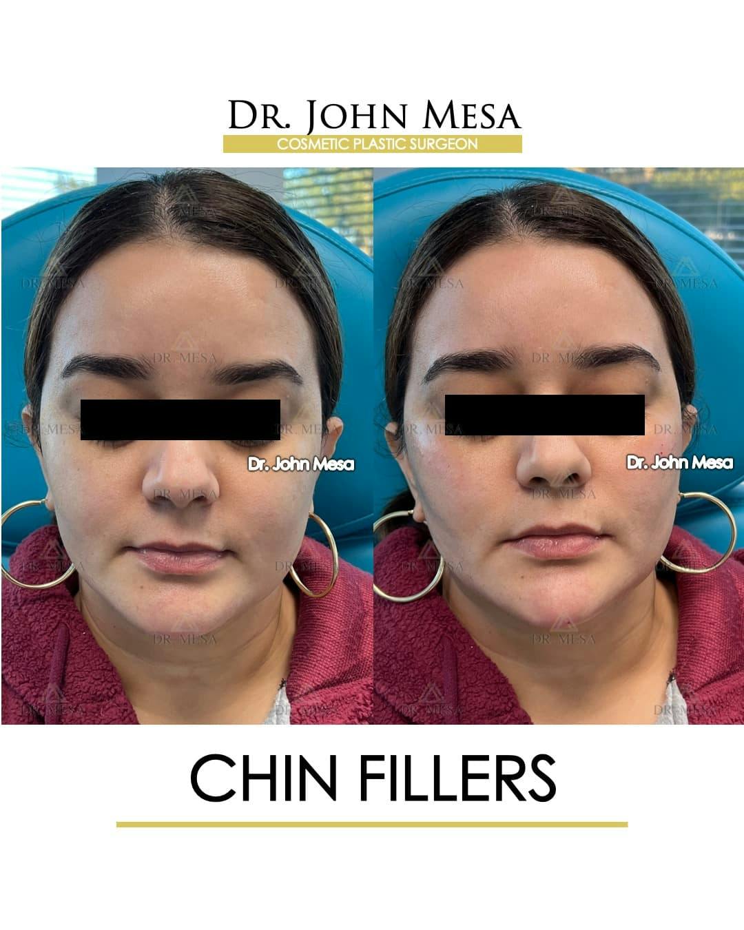 Chin Filler Before & After Gallery - Patient 366303 - Image 1