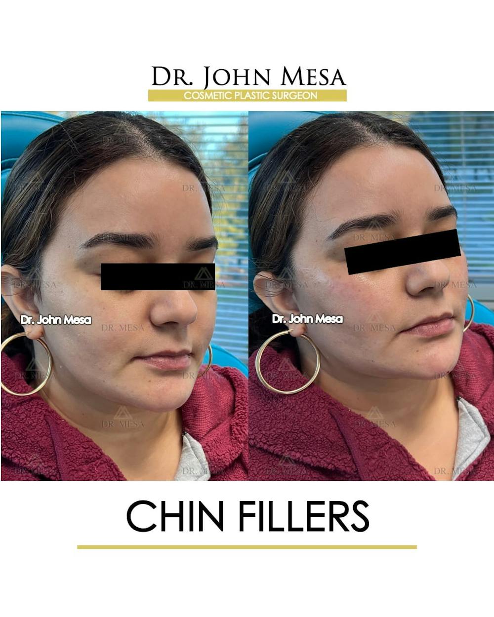 Chin Filler Before & After Gallery - Patient 366303 - Image 2
