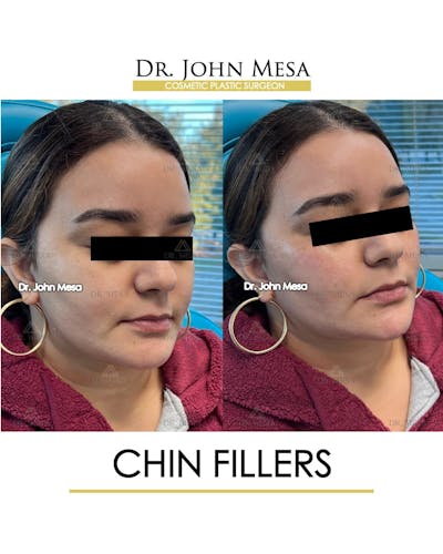 Chin Filler Before & After Gallery - Patient 366303 - Image 2