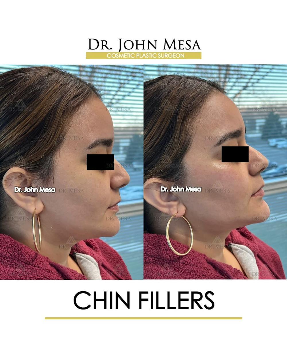 Chin Filler Before & After Gallery - Patient 366303 - Image 3