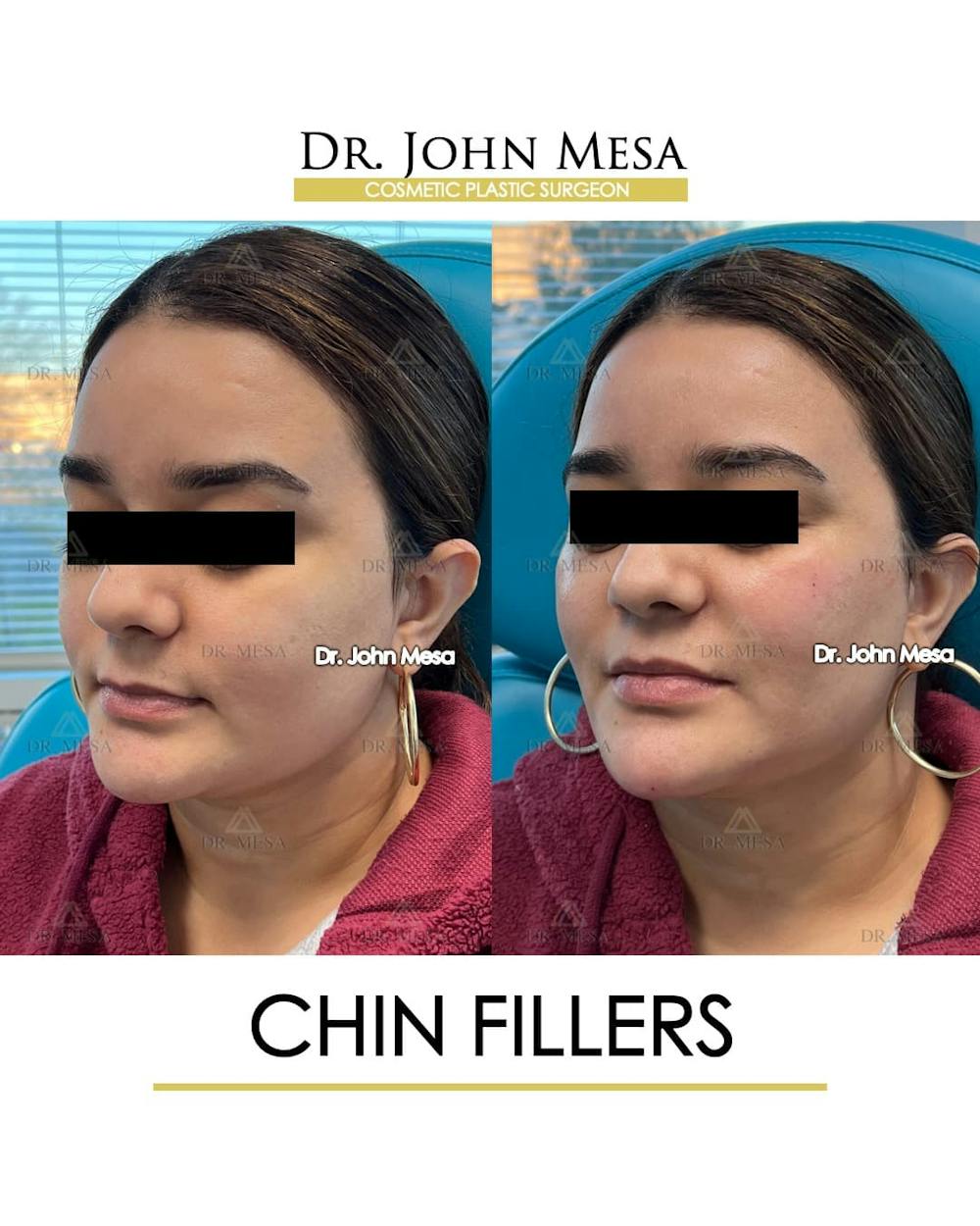 Chin Filler Before & After Gallery - Patient 366303 - Image 4