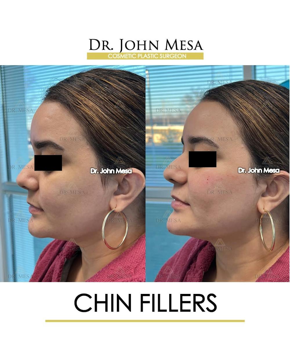 Chin Filler Before & After Gallery - Patient 366303 - Image 5
