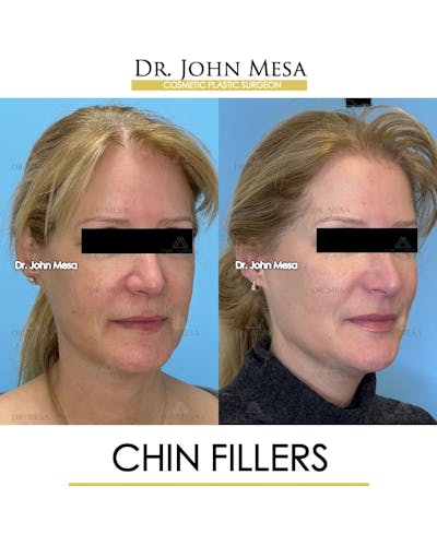 Chin Filler Before & After Gallery - Patient 132385 - Image 2