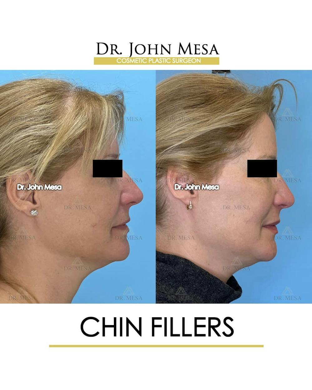 Chin Filler Before & After Gallery - Patient 132385 - Image 3