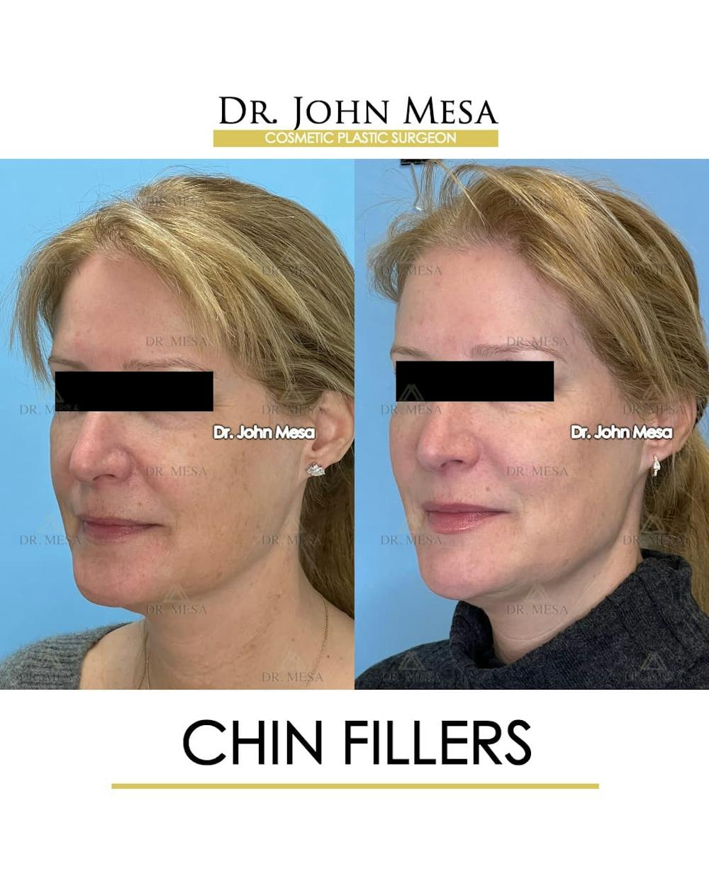 Chin Filler Before & After Gallery - Patient 132385 - Image 4