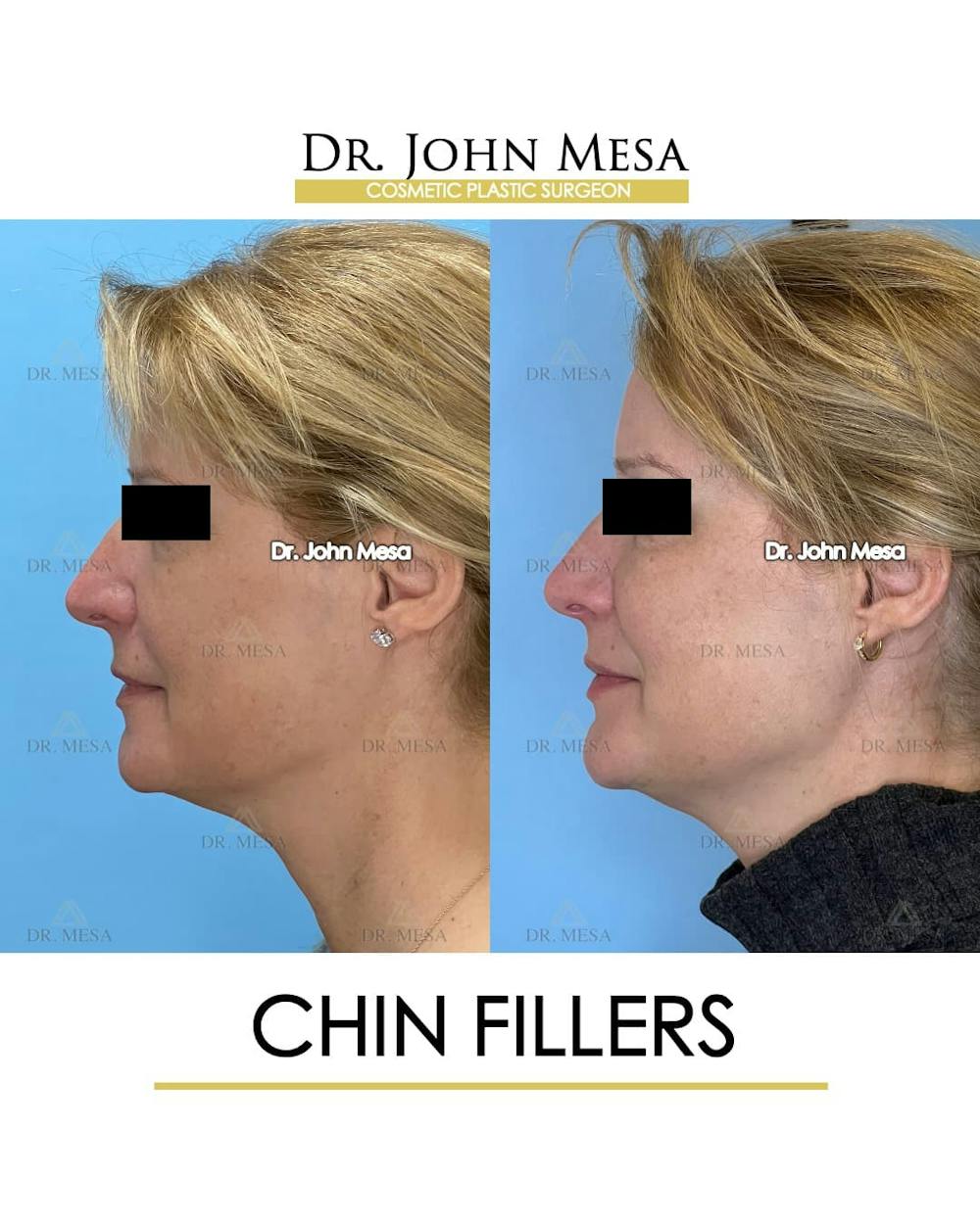 Chin Filler Before & After Gallery - Patient 132385 - Image 5