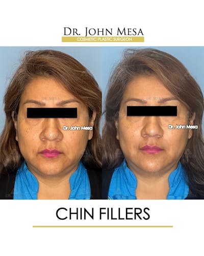 Chin Filler Before & After Gallery - Patient 280190 - Image 1