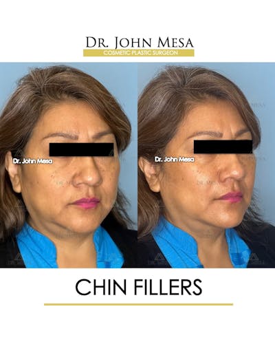 Chin Filler Before & After Gallery - Patient 280190 - Image 2