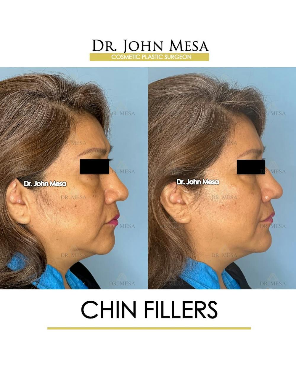 Chin Filler Before & After Gallery - Patient 280190 - Image 3