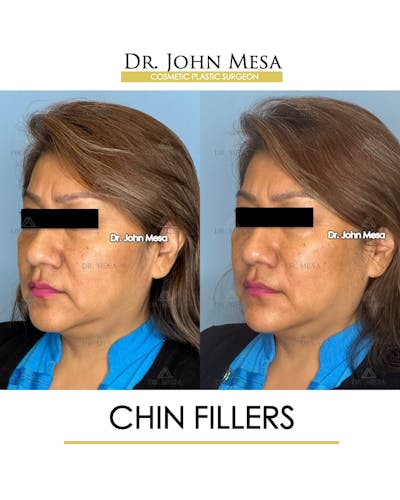 Chin Filler Before & After Gallery - Patient 280190 - Image 4
