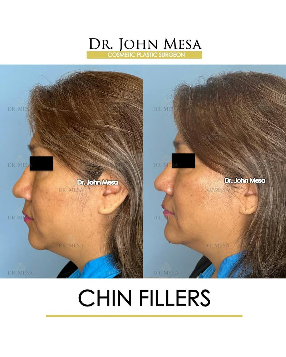 Chin Filler Before & After Gallery - Patient 280190 - Image 5