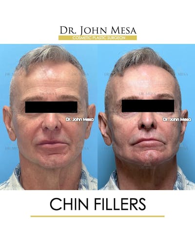 Chin Filler Before & After Gallery - Patient 346918 - Image 1