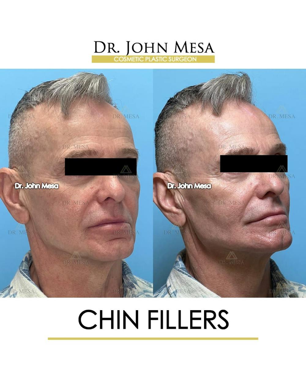 Chin Filler Before & After Gallery - Patient 346918 - Image 2