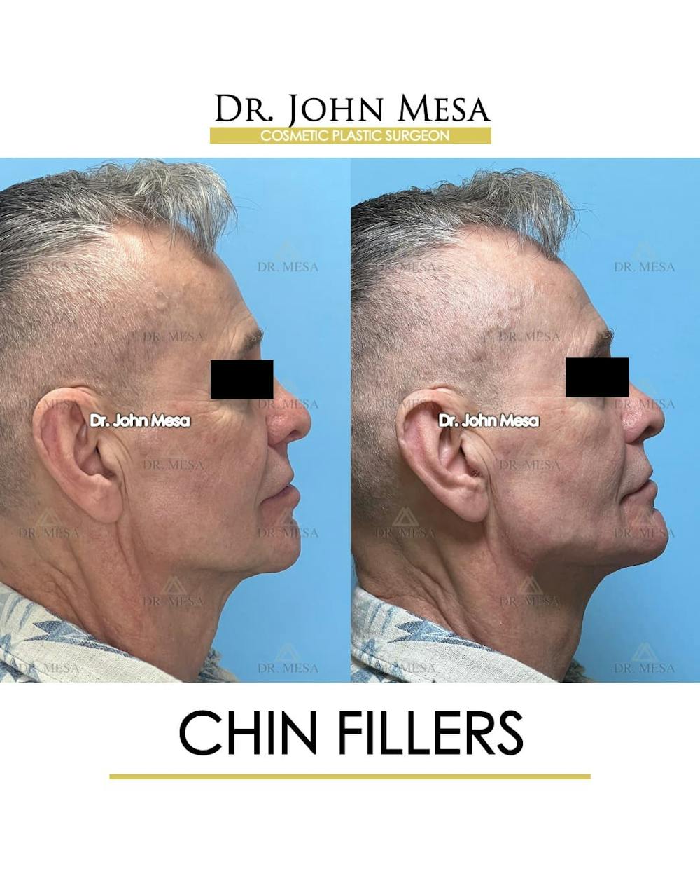 Chin Filler Before & After Gallery - Patient 346918 - Image 3