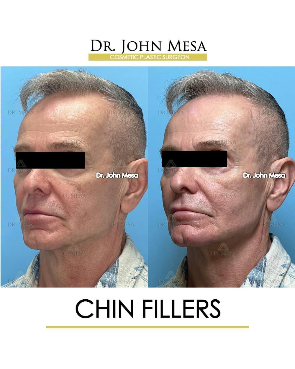 Chin Filler Before & After Gallery - Patient 346918 - Image 4