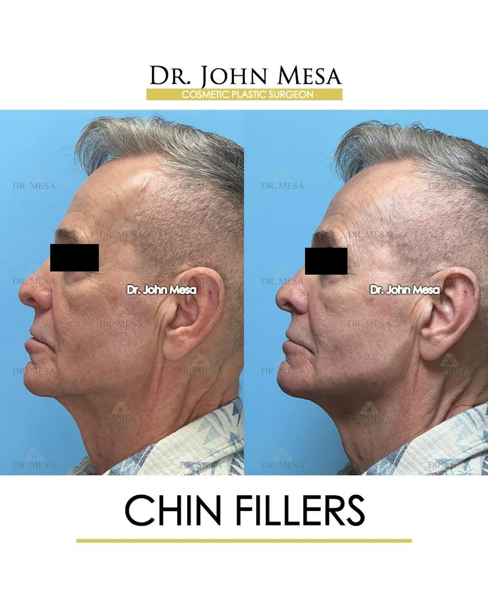 Chin Filler Before & After Gallery - Patient 346918 - Image 5