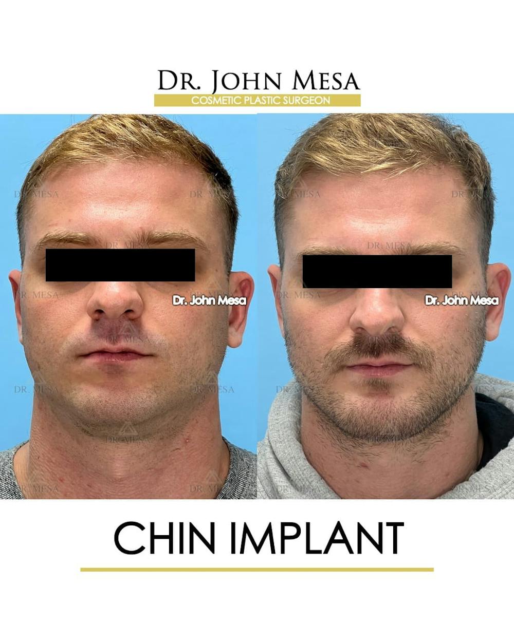 Chin Implant Before & After Gallery - Patient 260355 - Image 1