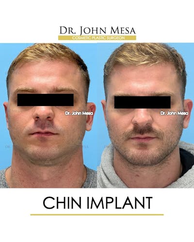 Chin Implant Before & After Gallery - Patient 260355 - Image 1