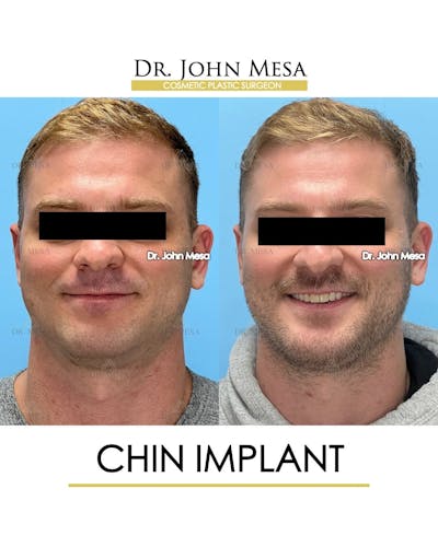 Chin Implant Before & After Gallery - Patient 260355 - Image 2