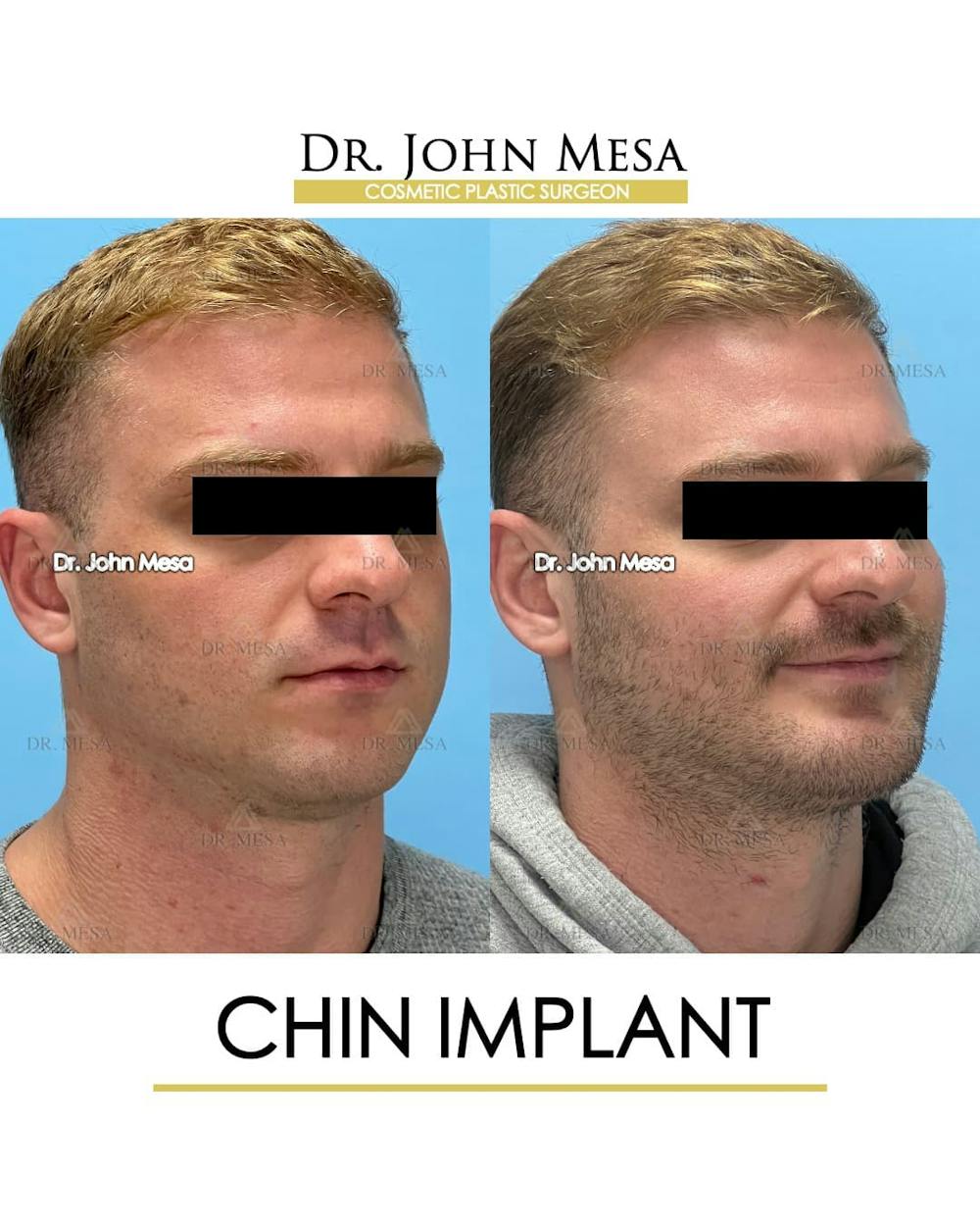 Chin Implant Before & After Gallery - Patient 260355 - Image 3