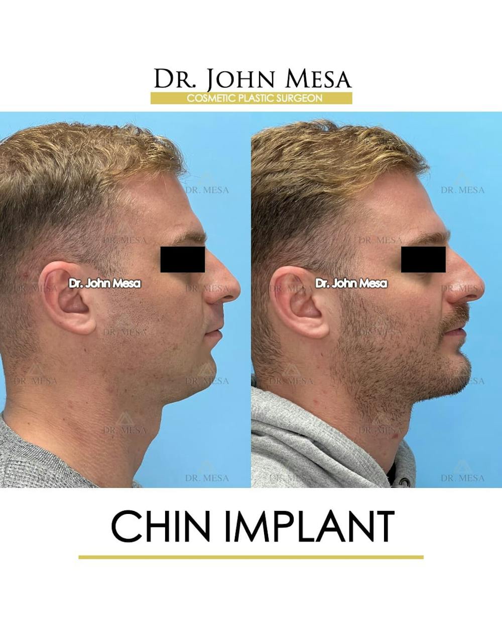 Chin Implant Before & After Gallery - Patient 260355 - Image 4