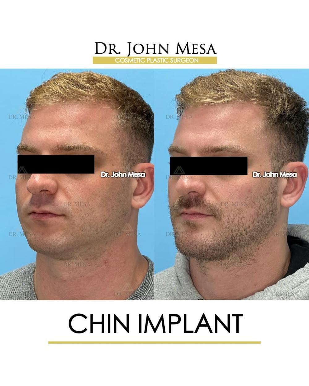 Chin Implant Before & After Gallery - Patient 260355 - Image 5