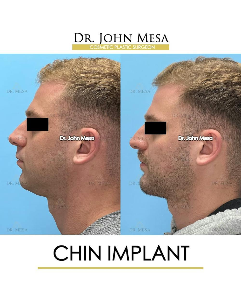 Chin Implant Before & After Gallery - Patient 260355 - Image 6