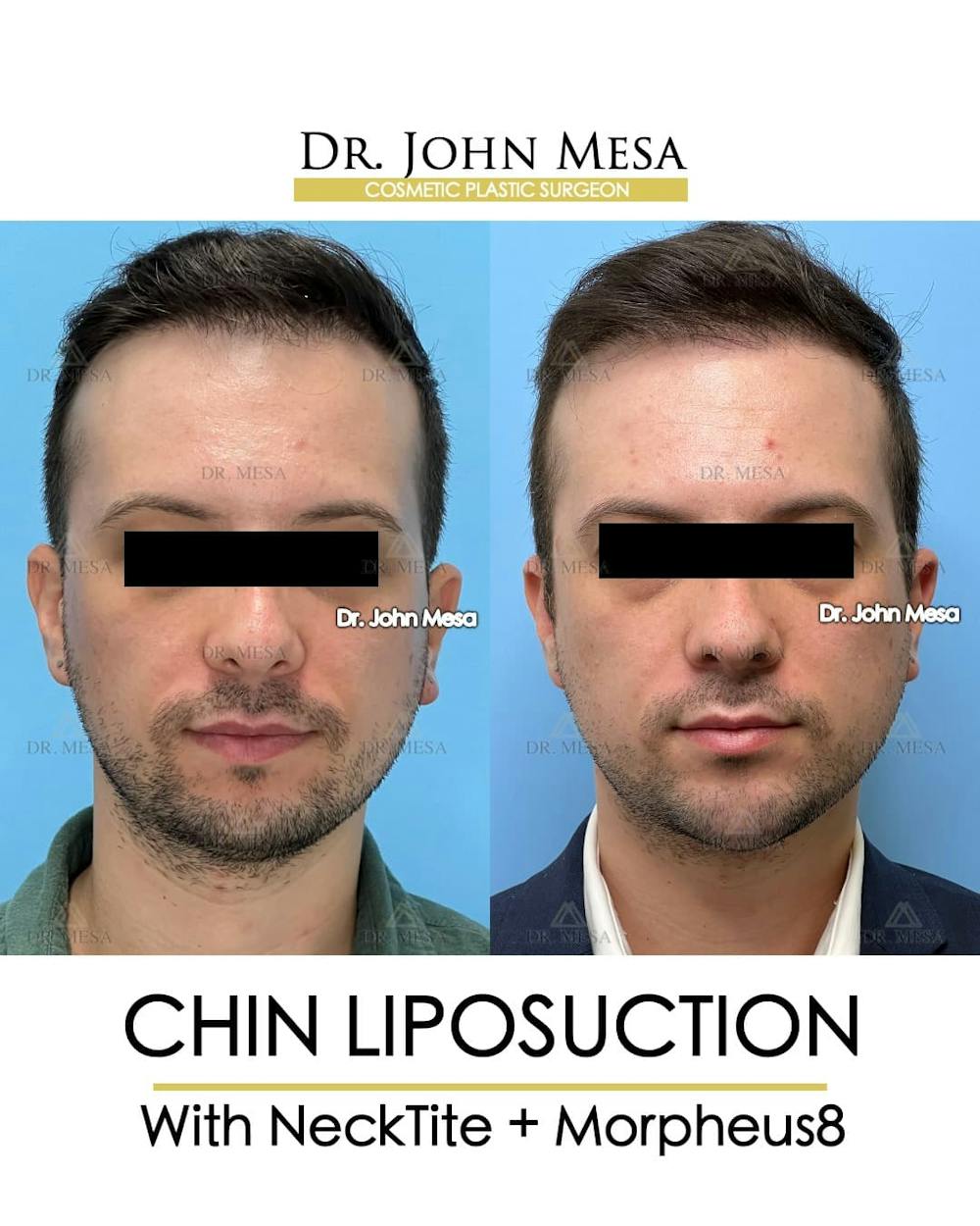 Chin Liposuction Before & After Gallery - Patient 143833 - Image 2