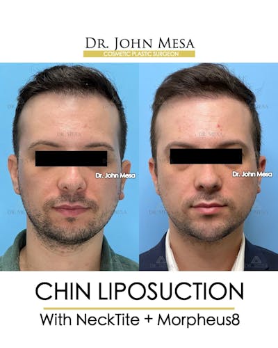 Chin Liposuction Before & After Gallery - Patient 143833 - Image 1