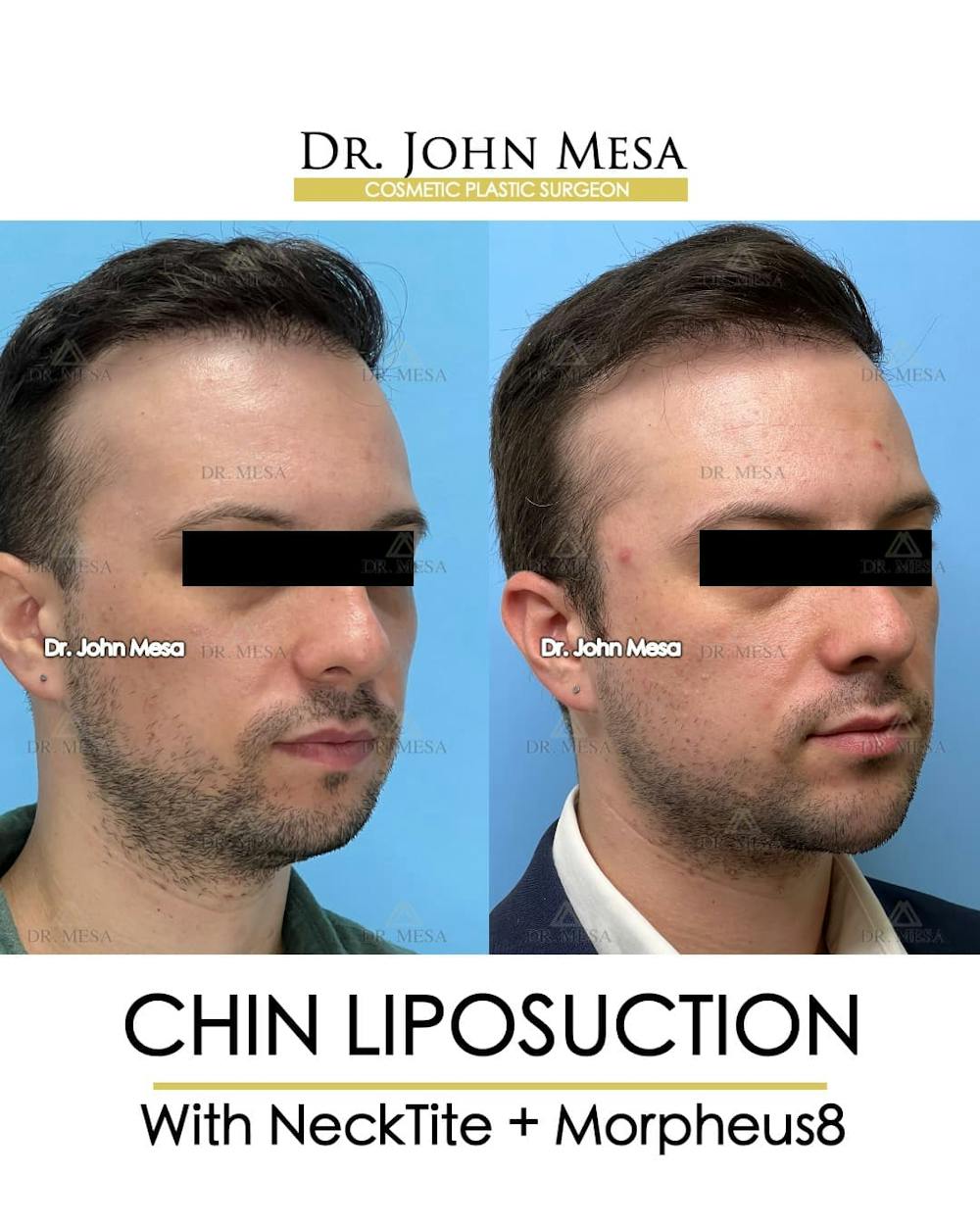 Chin Liposuction Before & After Gallery - Patient 143833 - Image 3