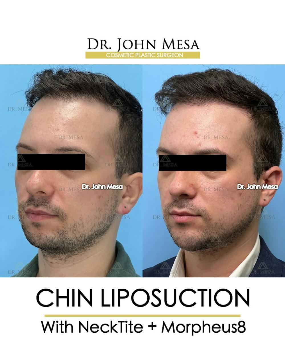 Chin Liposuction Before & After Gallery - Patient 143833 - Image 4