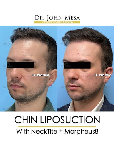 Chin Liposuction Before & After Gallery - Patient 143833 - Image 4